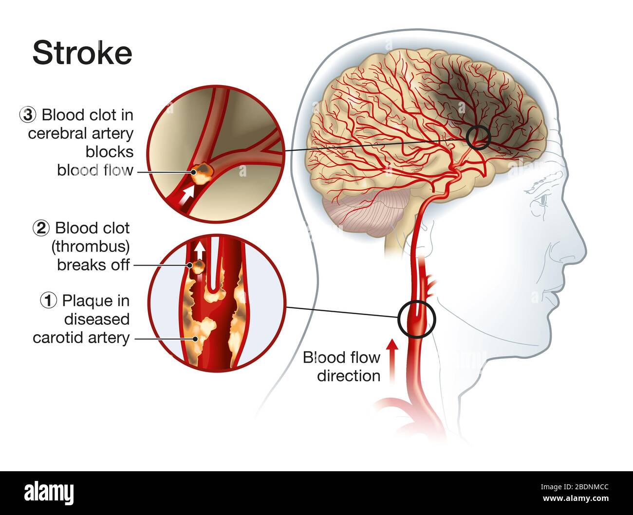 Illustration showing plaque in carotid artery, blood clot breaking off and blocking blood flow Stock Photo