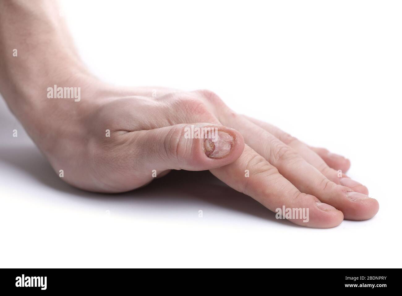 Fungal Nail Infection and Damage on Human Hand. Finger with Onychomycosis,  Disgusting Bitten Fingernails on Man`s Hand Stock Photo - Image of bitten,  ciclopirox: 92516850