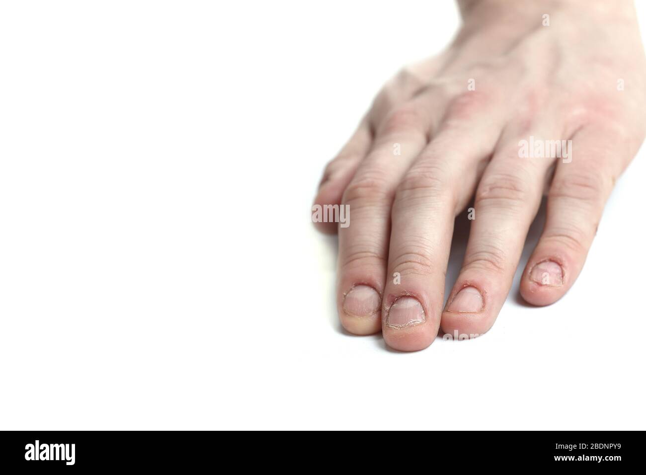 Fungus Infection on Nails Hand, Finger with Onychomycosis. - Soft Focus  Stock Photo - Image of focus, discomfort: 76640020