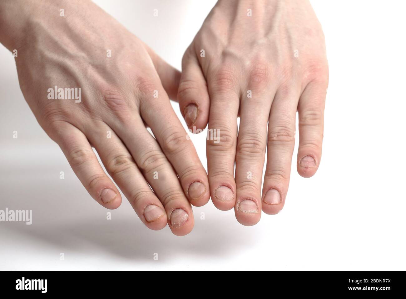 Fungus Infection On Nails Hand, Finger With Onychomycosis, A Toenail Fungus.  - Soft Focus Stock Photo, Picture and Royalty Free Image. Image 61706069.