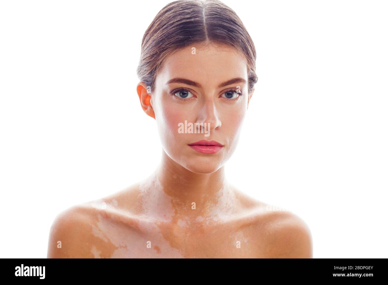 beautiful young woman with vitiligo disease isolated on white positive smiling, model