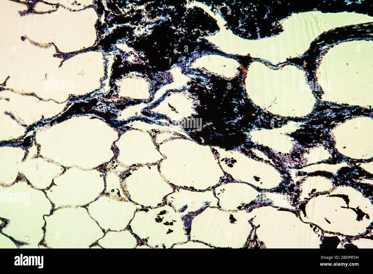 Diseased lung hires stock photography and images Alamy