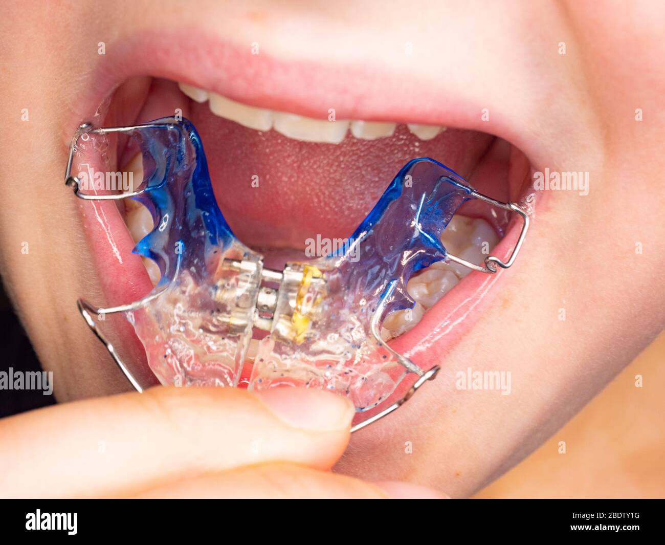 Patient photo of teeth with orthodontic braces. Wearing of braces is