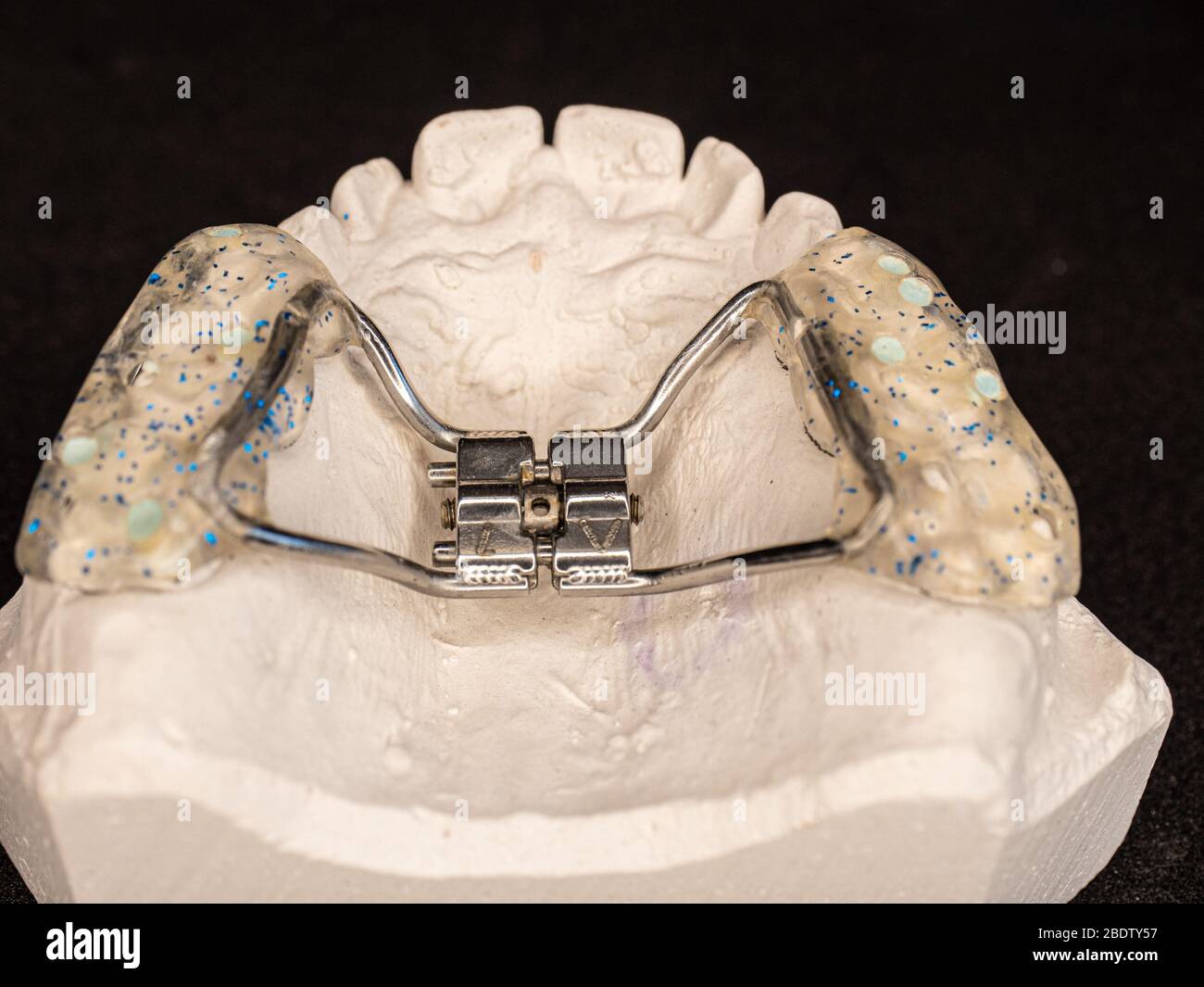 Temporary used orthodontic appliance to make young upper jaw wider