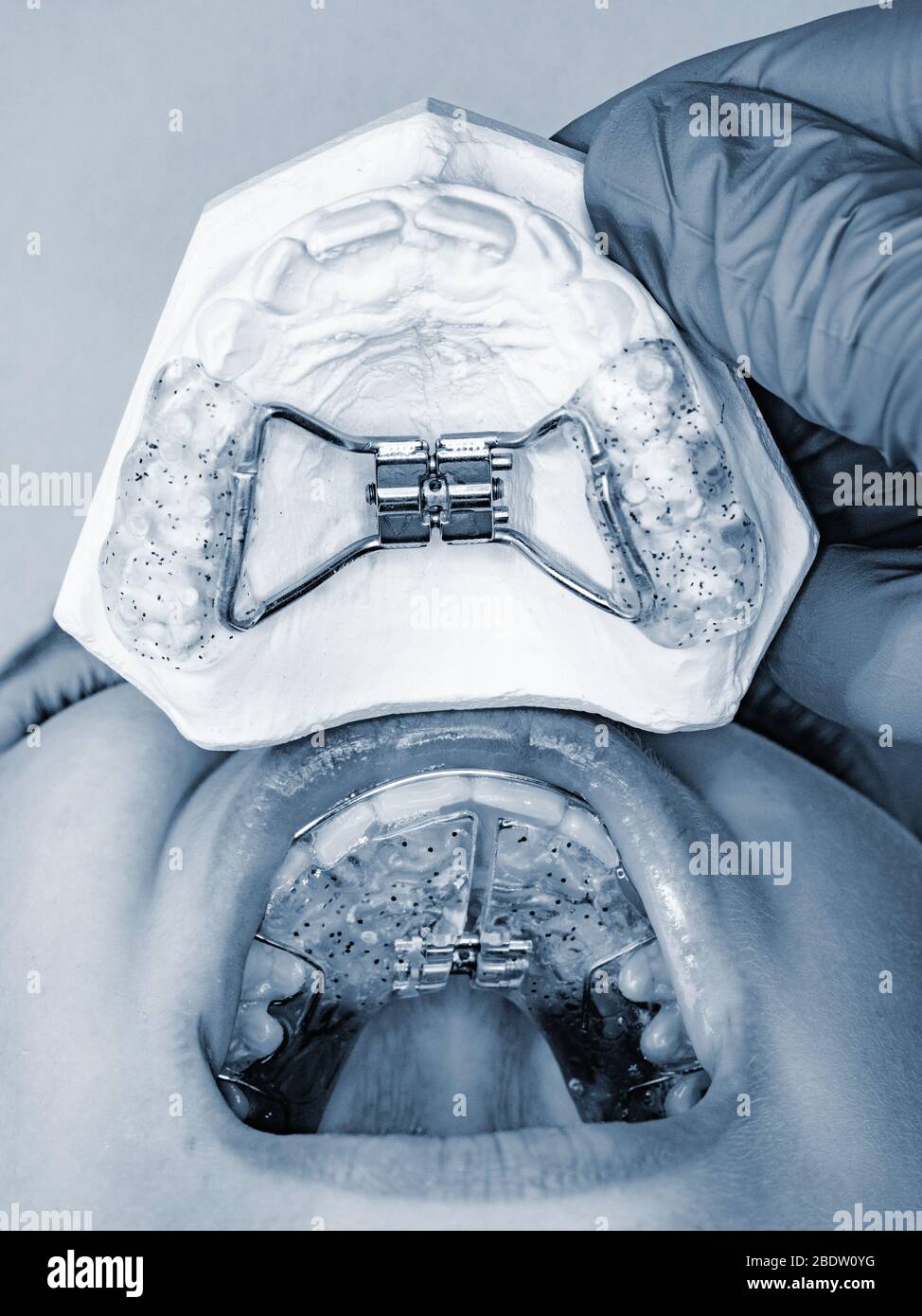 Dental braces. Teeth cast and child jaw with braces installed. To align