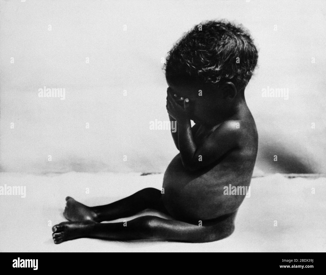 Kwashiorkor hi-res stock photography and images - Alamy