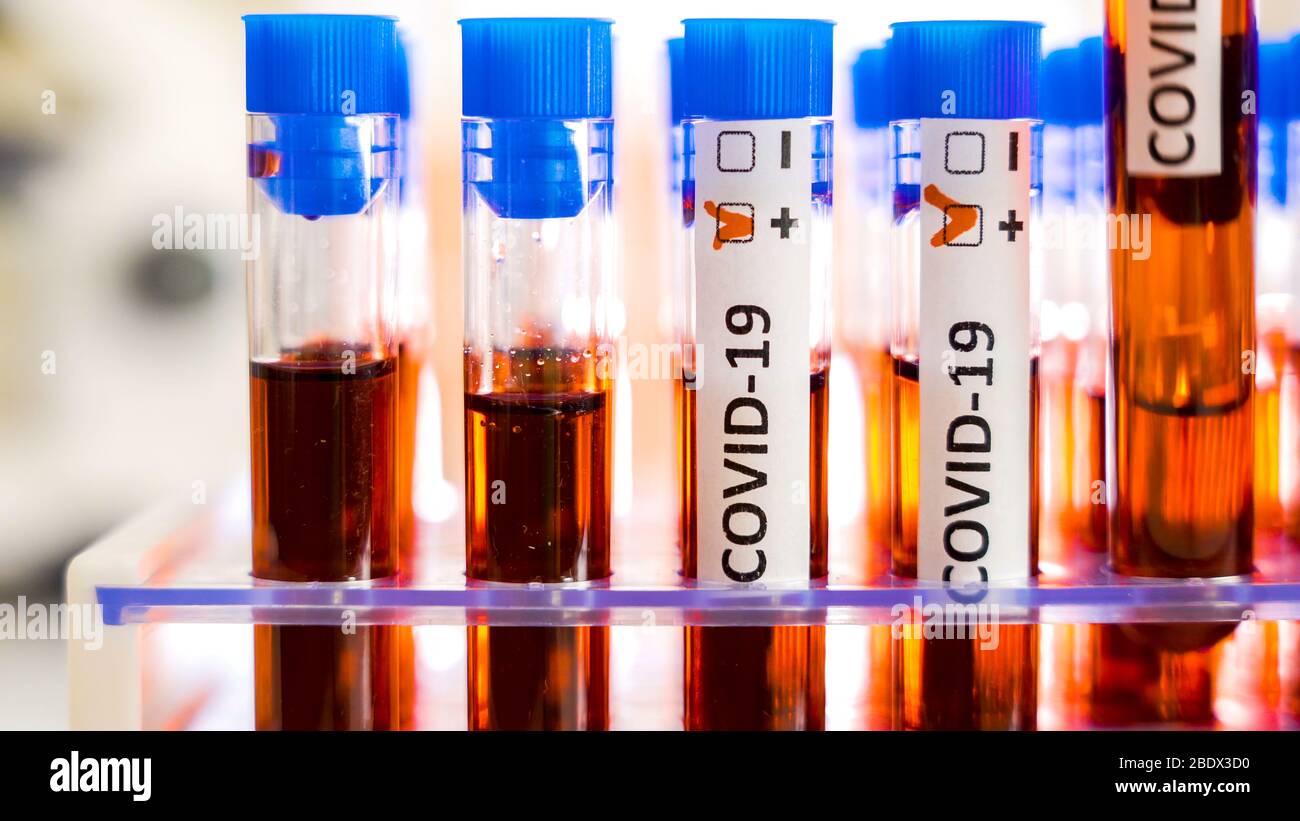 Postive Kit Closer look of the positive test kits for COVID-19 coronavirus on the ...