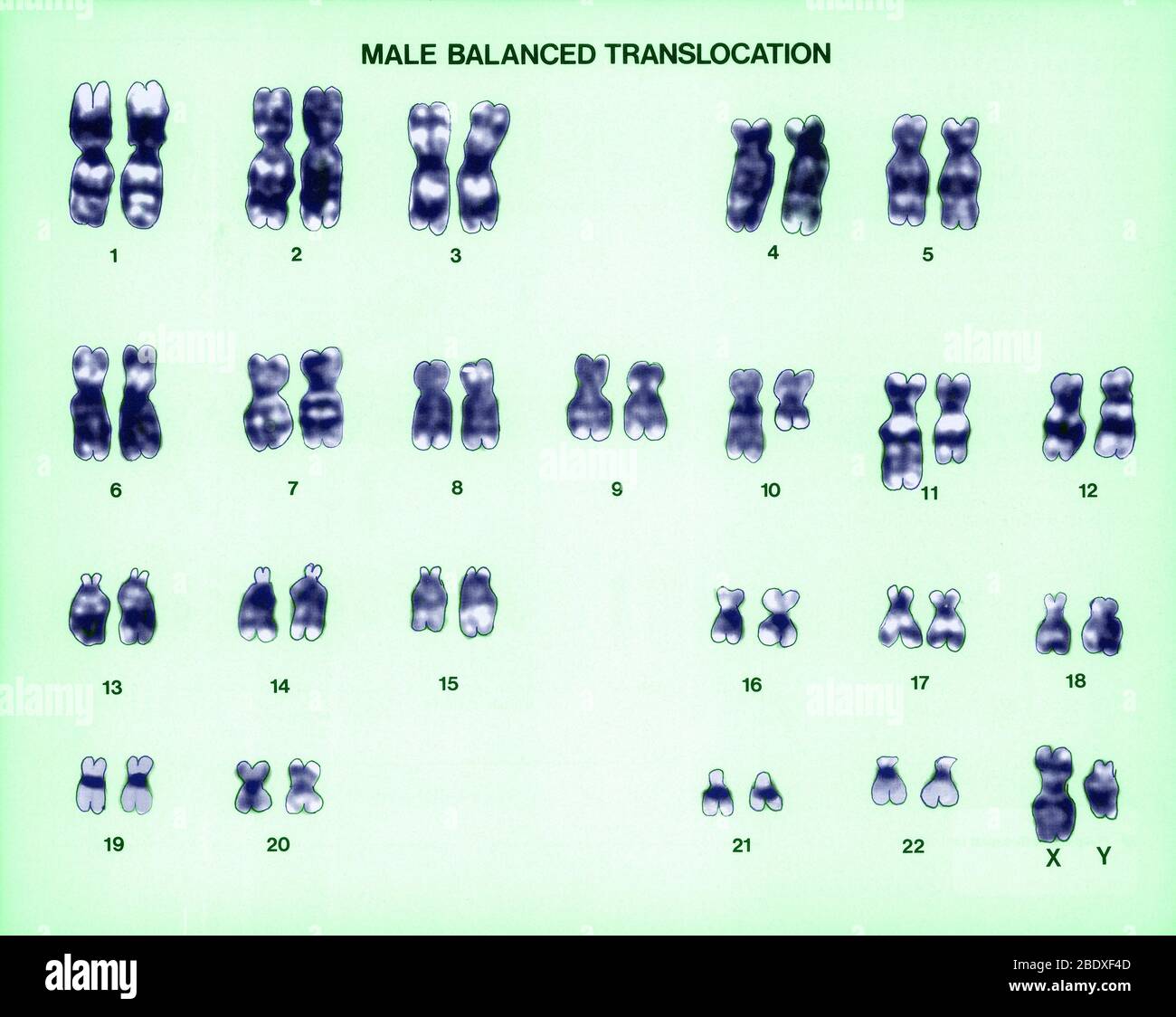 Male Balanced Translocation Karyotype Stock Photo