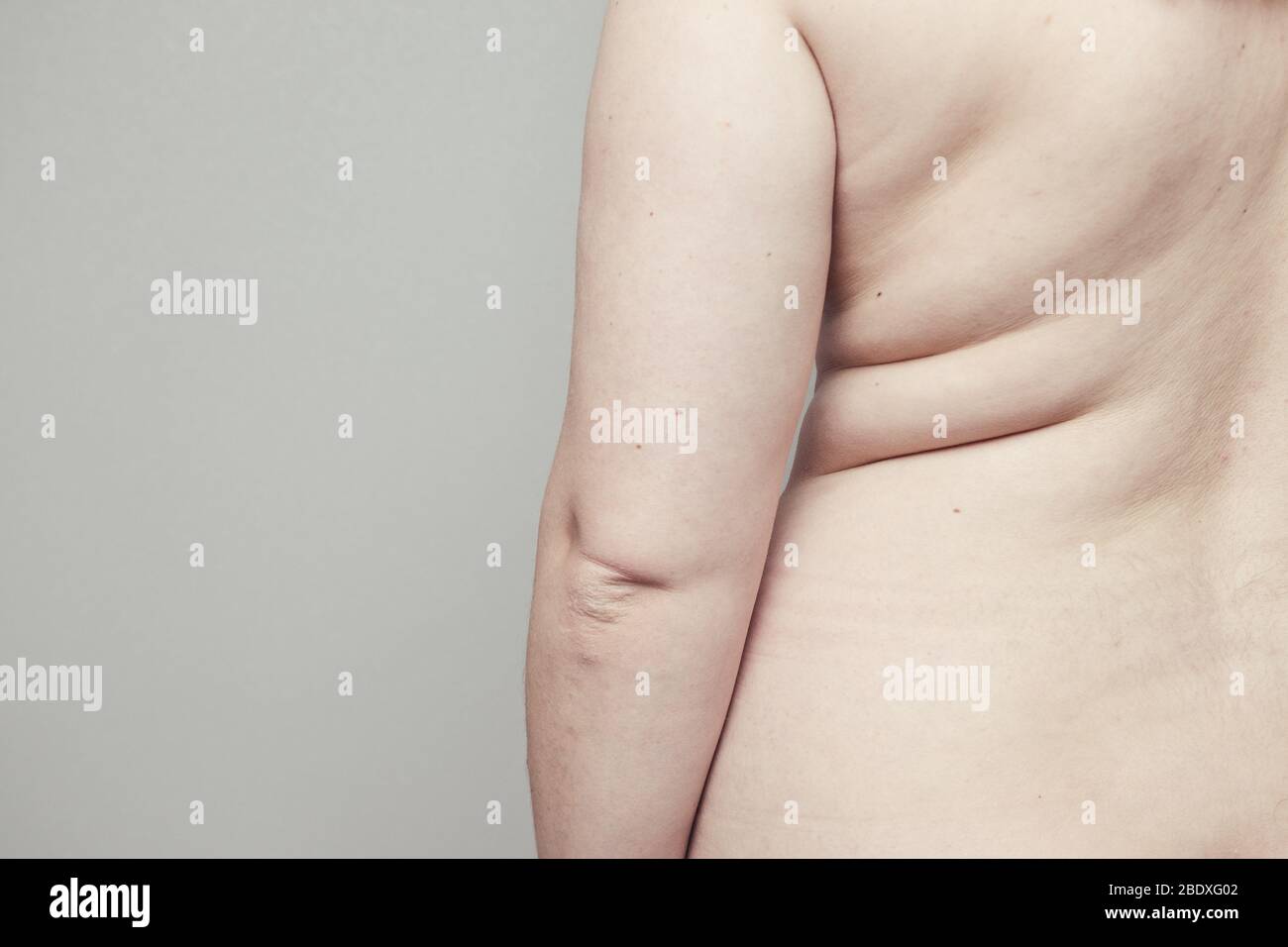 Overweight, fat body concept. The effect of insulin on the human body. Diet Stock Photo