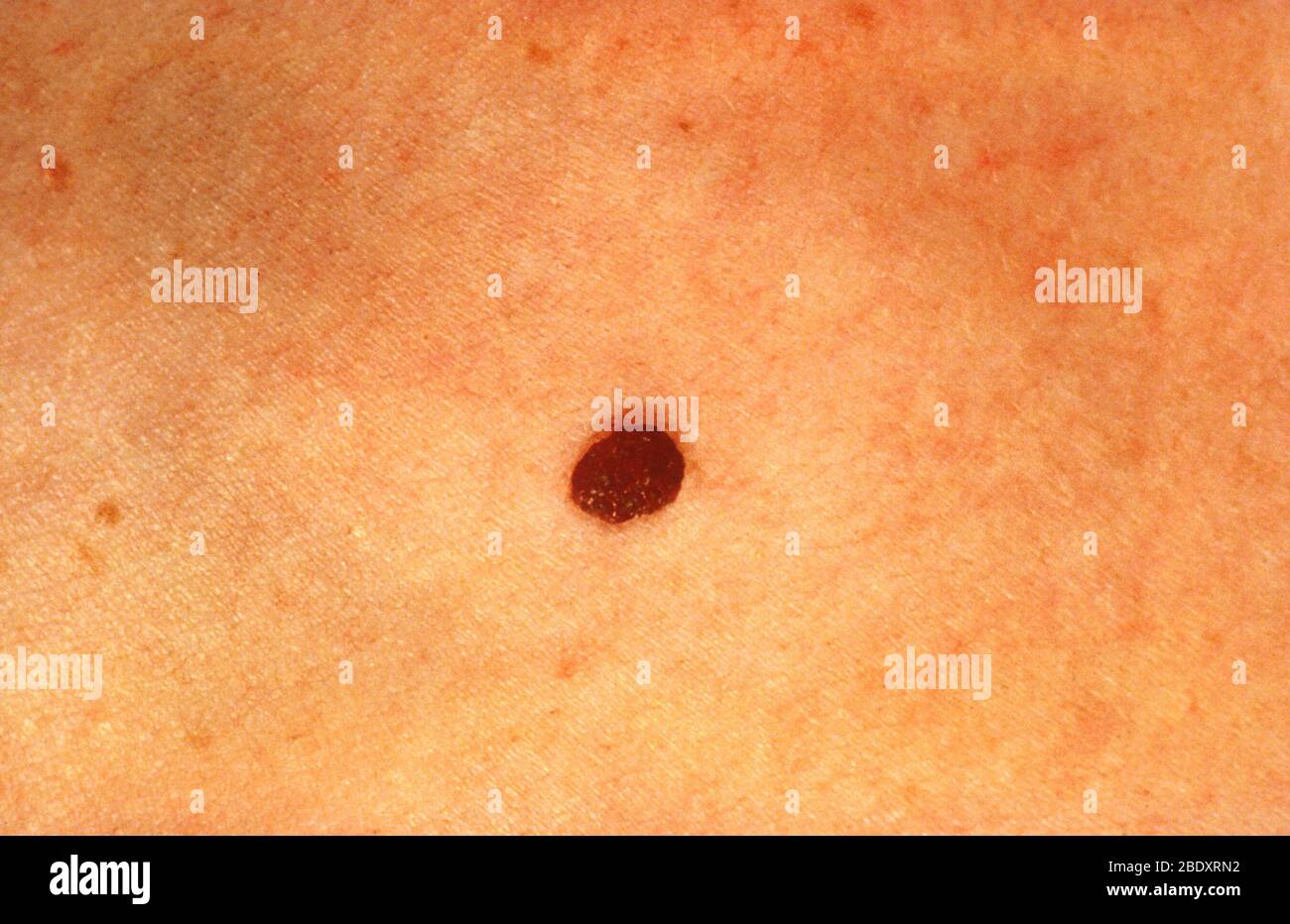 Normal mole Stock Photo