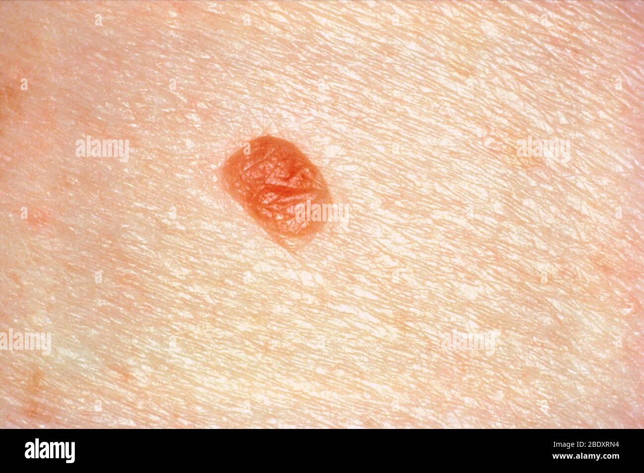 Normal mole Stock Photo