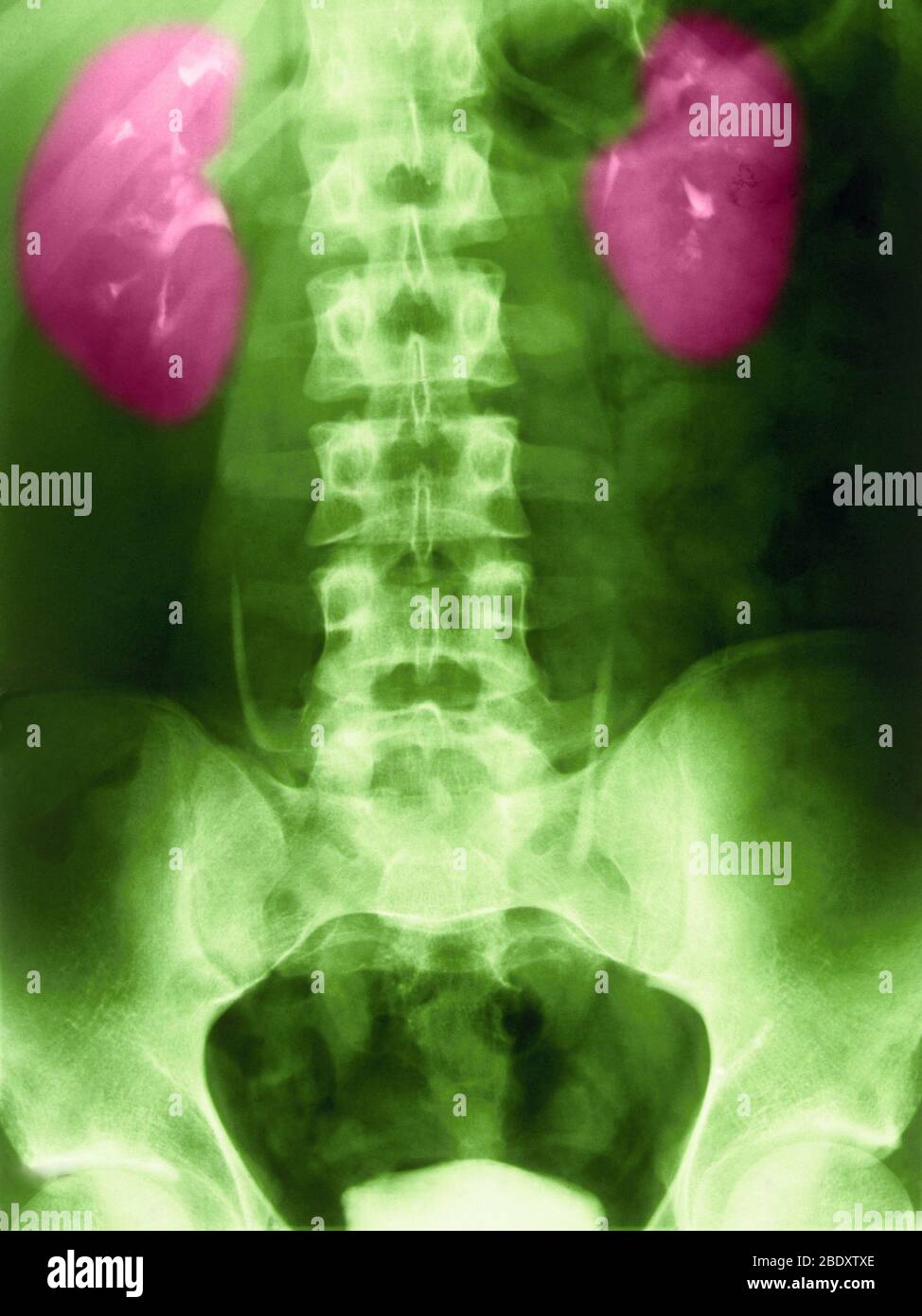 Normal Rennal X-ray of Normal Kidneys Stock Photo - Alamy
