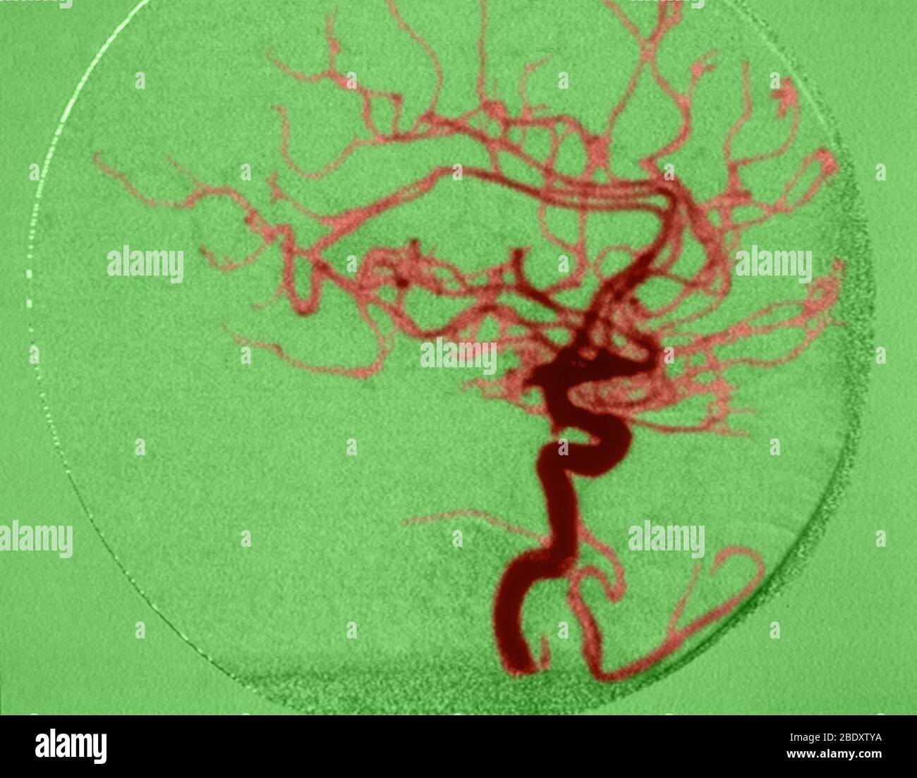 Cerebral Angiogram Stock Photo