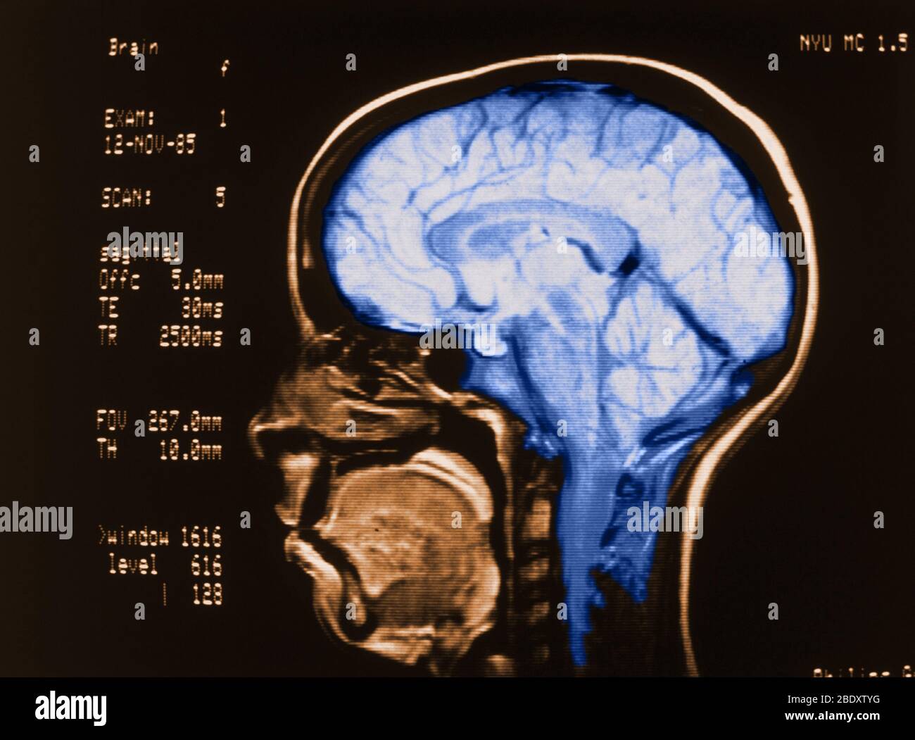 Cerebral Angiography Stock Photo