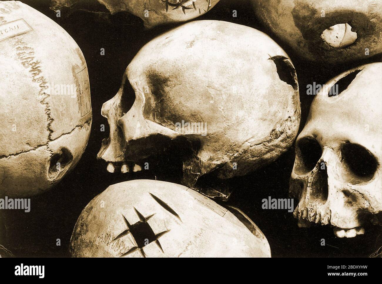 Skulls Showing Trepanation Stock Photo