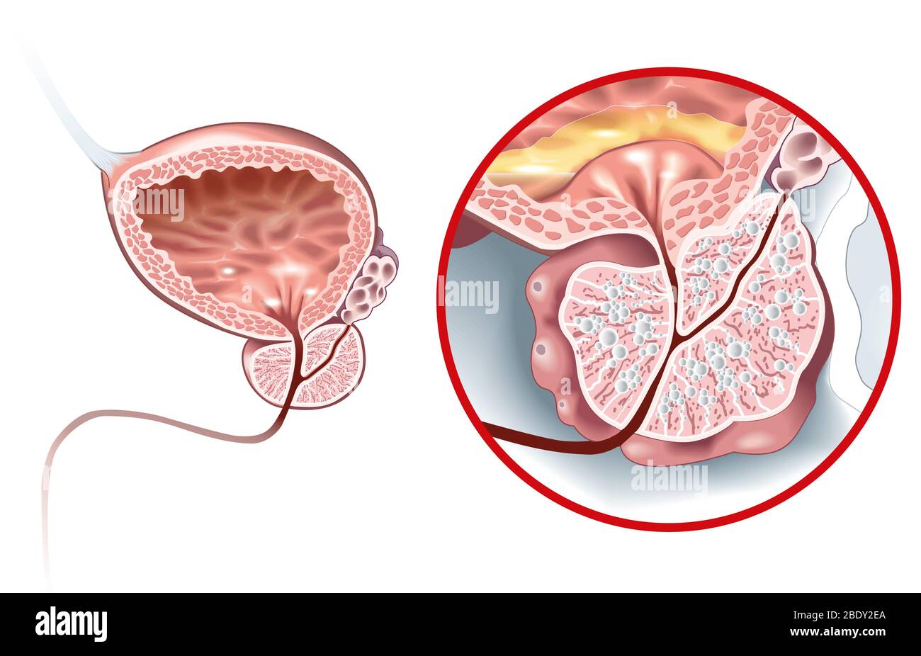 Illustration Showing Healthy Prostate And Benign Prostatic Hyperplasia Bph Enlarged Prostate 