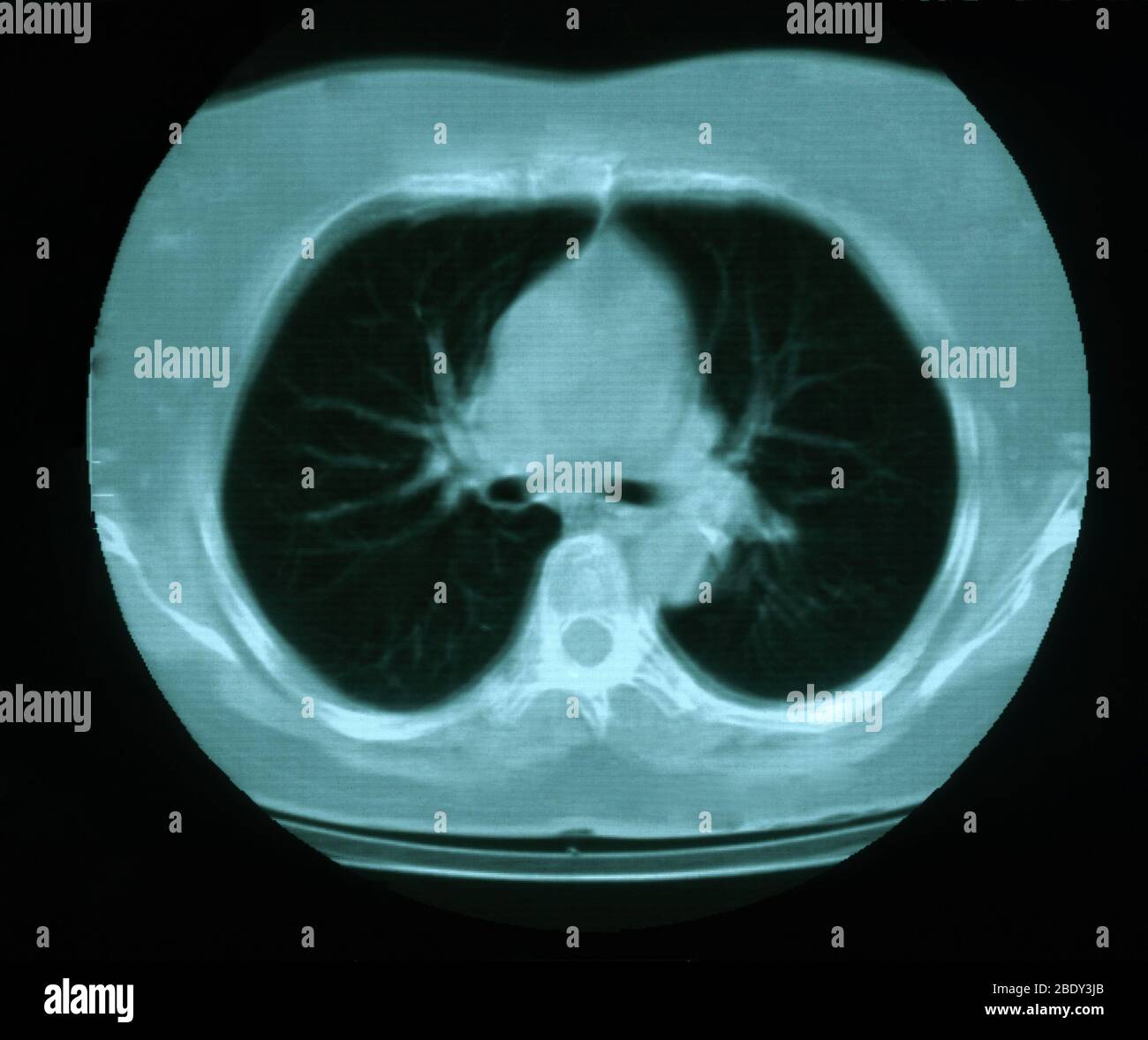 Granuloma & Calcification in Lung Stock Photo