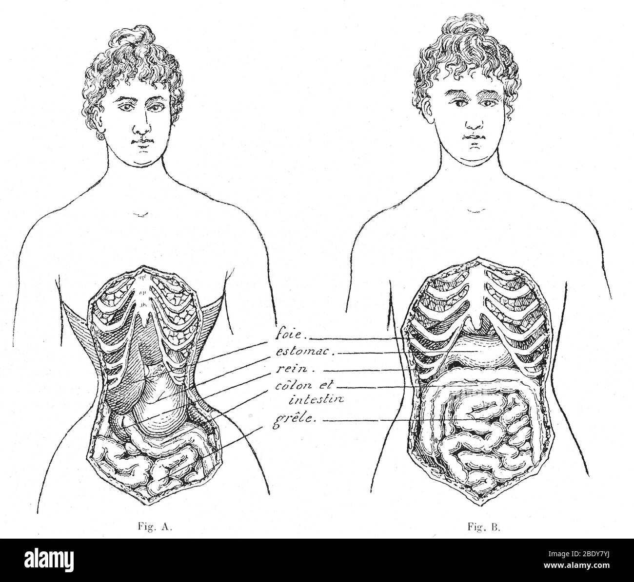 Medical Crimes of the Corset, 1908 Stock Photo