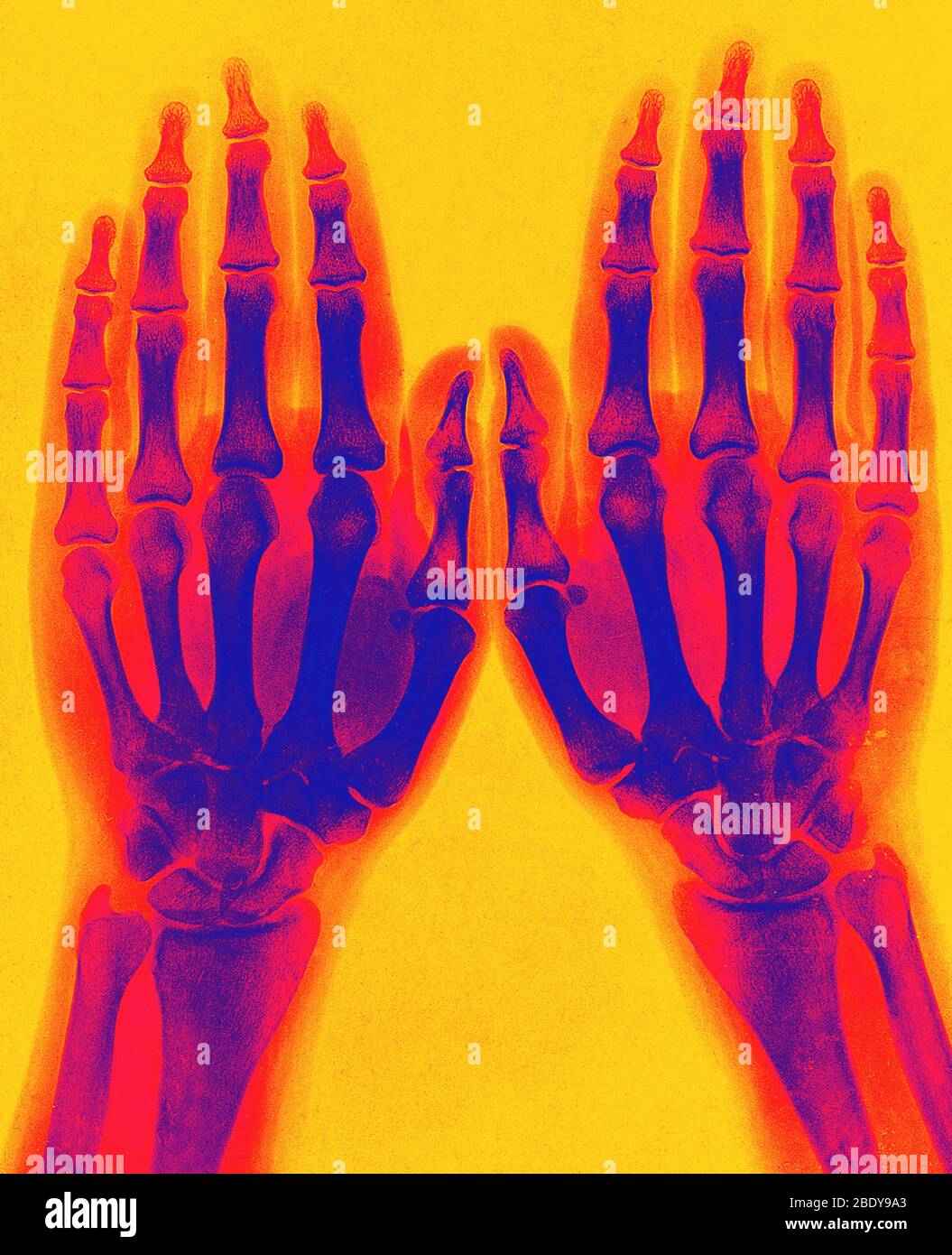 X-Ray of Two Normal Hands, 1896 Stock Photo