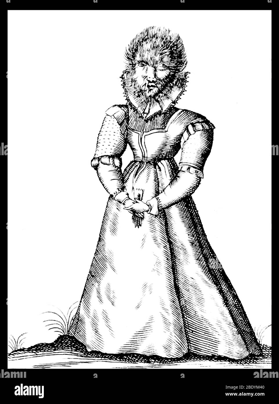Hypertrichosis, 1622 Stock Photo