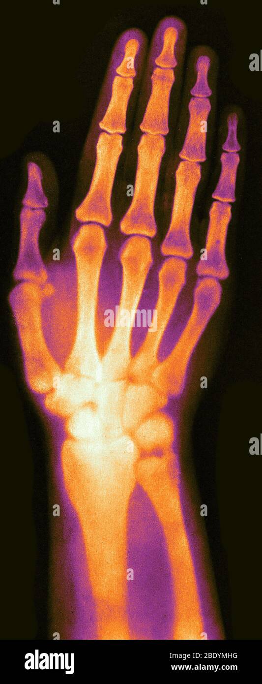 Xray of Woman's Hand, 1896 Stock Photo Alamy