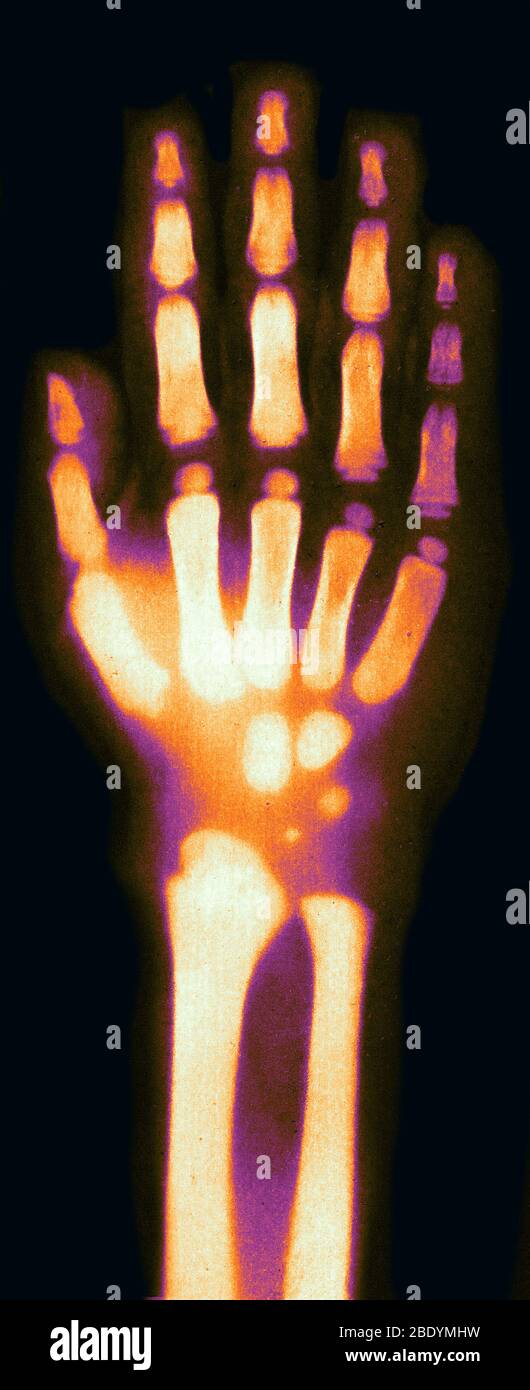X-ray of Child's Hand, 1896 Stock Photo