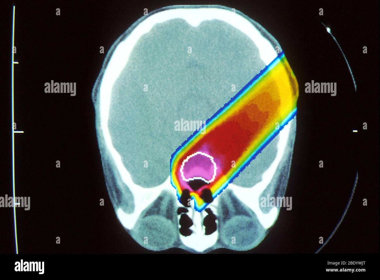 Proton beam from brain during CT scan Stock Photo