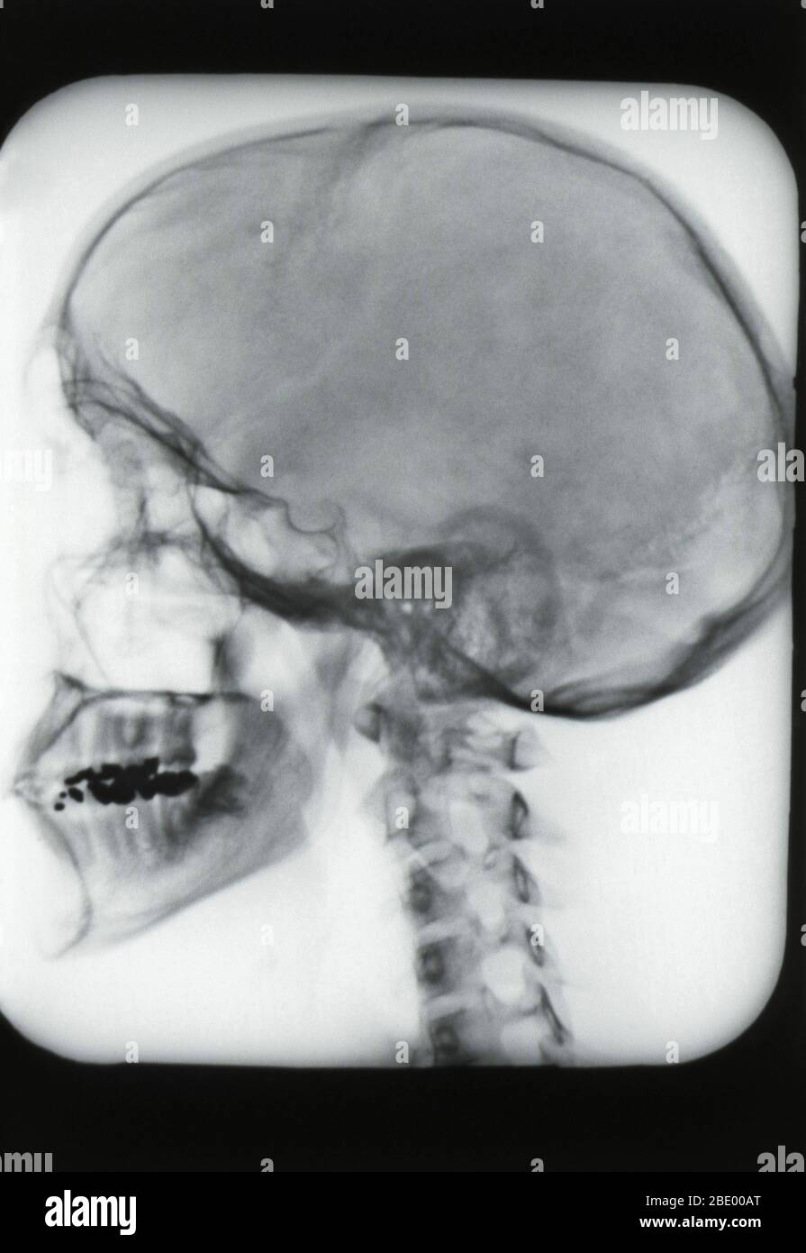 Normal Skull, X-ray Stock Photo