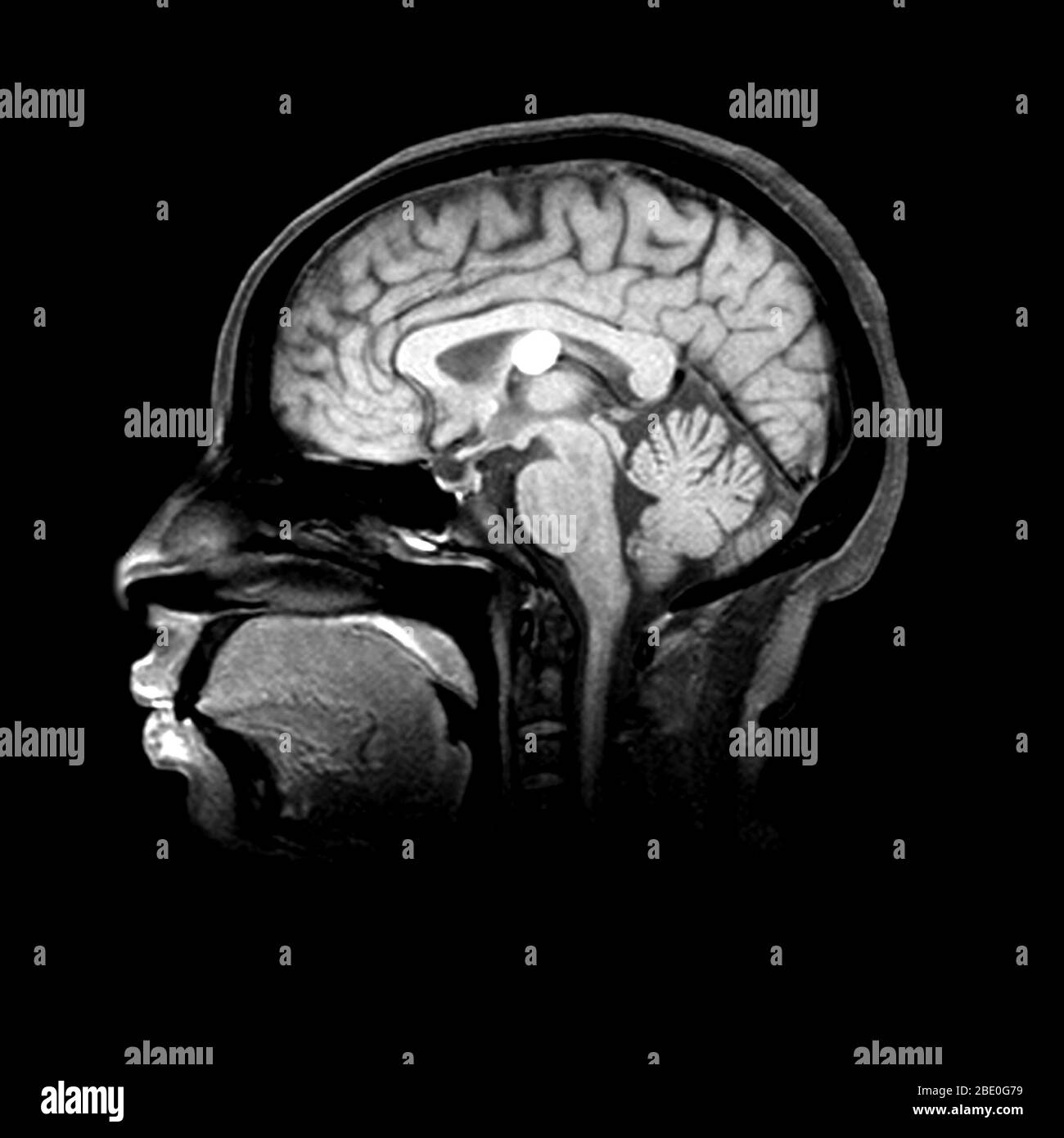 ventricles of the brain mri