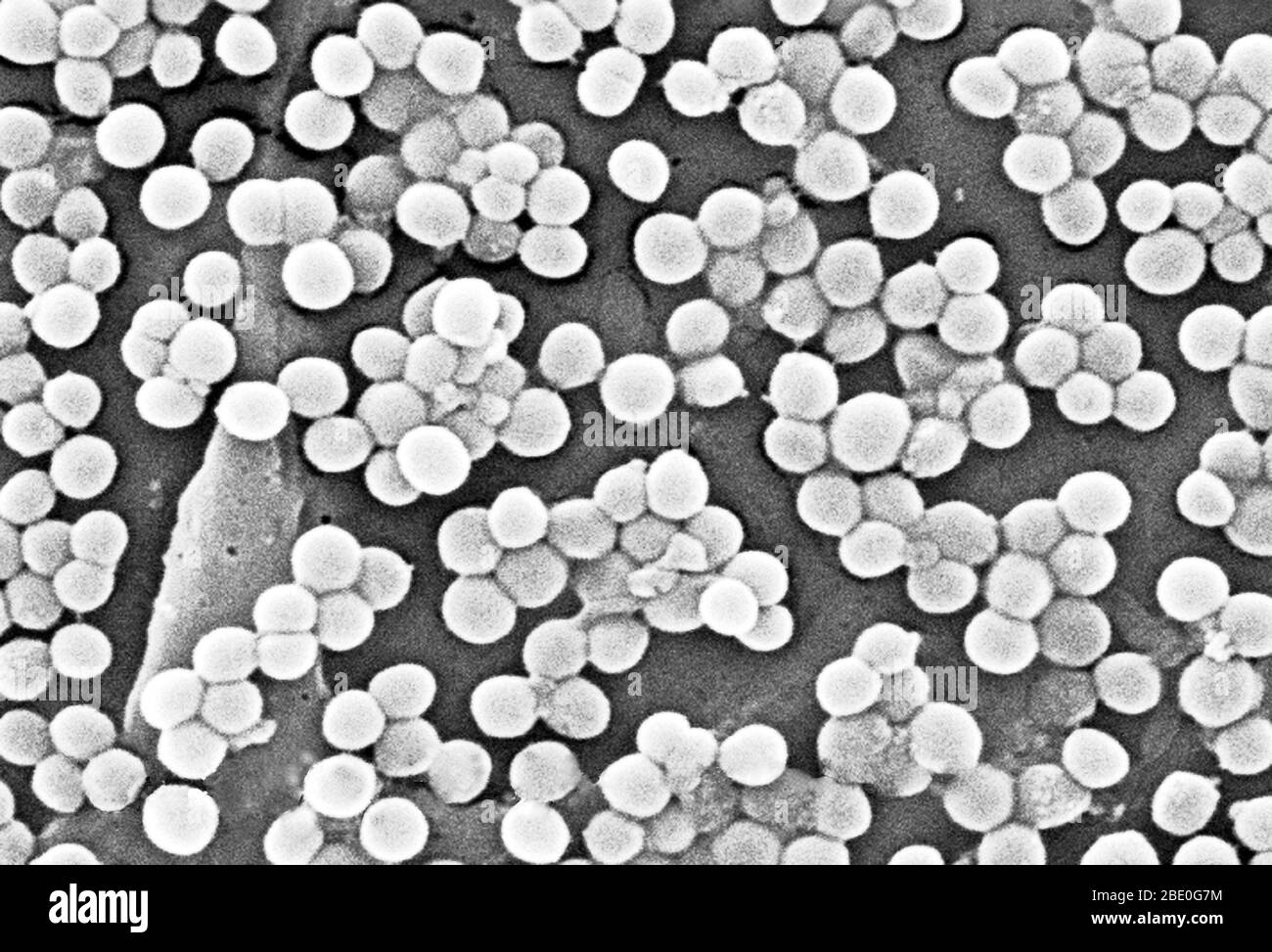 Numerous clumps of methicillin-resistant Staphylococcus aureus bacteria, commonly referred to by the acronym MRSA. Recently recognized outbreaks or clusters of MRSA in community settings have been associated with strains that have some unique microbiologic and genetic properties compared to the traditional hospital-based MRSA strains. This suggests that some biologic properties, e.g., virulence factors like toxins, may allow the community strains to spread more easily or cause more skin disease. A common strain named USA300-0114 has caused many such outbreaks in the United States. Staphylococc Stock Photo