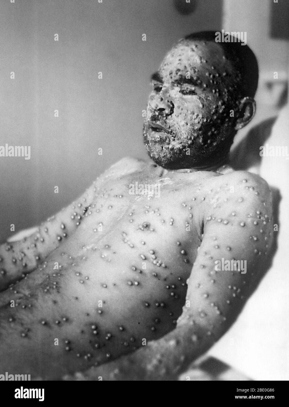Smallpox is an acute, infectious viral disease transmitted by direct contact with infected people. Fever symptoms commence 8-18 days after exposure. After 3 days, red spots appear on the face and body and develop into pea-size pustules. Scabs formed by the drying of the pustules leave permanent scars. Most patients recover, but nephritis and pneumonia occur as complications. In 1980, the World Health Organization declared smallpox an extinct disease after a worldwide vaccination campaign. Stock Photo