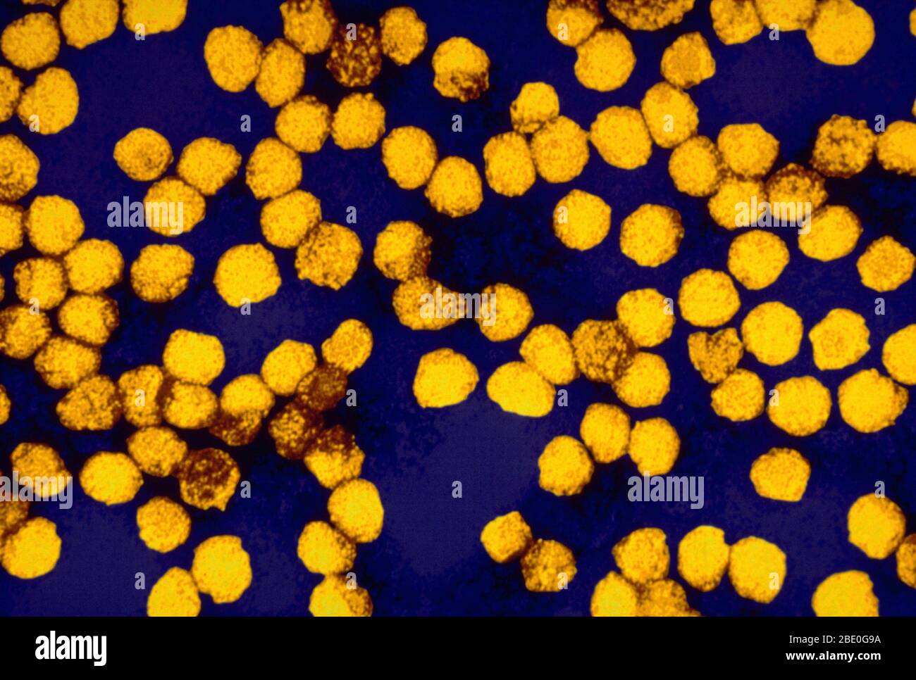 Color enhanced Transmission Electron Micrograph (TEM) of yellow fever virus virions. Yellow fever is caused by the yellow fever virus of the family Flaviviridae. It was the first illness shown to be transmissible by filtered human serum and transmitted by mosquitoes, by Walter Reed around 1900. The positive-sense, single-stranded RNA is around 11,000 nucleotides long and has a single open reading frame encoding a polyprotein. Yellow fever is a viral disease of typically short duration. In most cases, symptoms include fever, chills, loss of appetite, nausea, muscle pains particularly in the bac Stock Photo