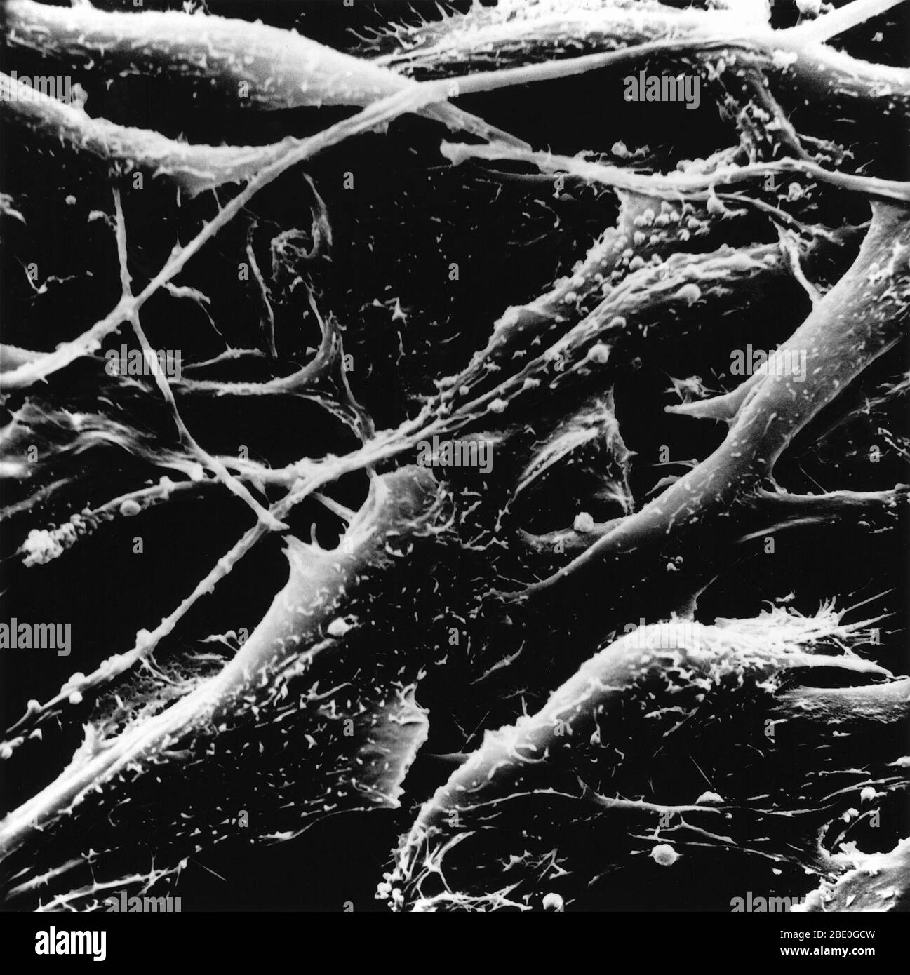 Human melanoma, a type of skin cancer. Magnification x130 Stock Photo