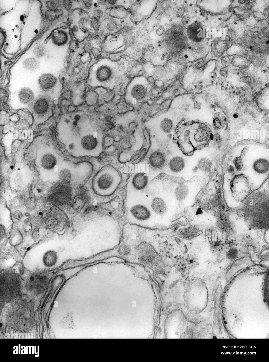 Negatively-stained transmission electron micrograph (TEM) of numerous Ganjam virus virions in tissue specimen. This Bunyaviridae family member is antigenically, closely related to, and an Asian variant of, the Nairobi sheep disease virus (NSDV). Though not contagious, Ganjam virus is an arbovirus, spread through the bite of certain ticks, including Hemaphysalis intermedia and Rhipecephalus hemaphysaloides. The largest family of viruses, Bunyaviridae are negative-sense single-stranded RNA viruses ((-) ssRNA), which are spread through contact with infected arthropods and rodents. Stock Photo