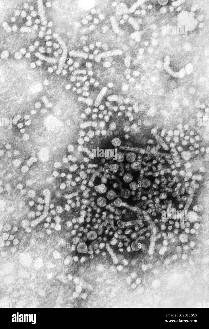 Negatively-stained transmission electron micrograph (TEM) of numerous hepatitis B virus (HBV) virions, also known as Dane particles. HBV contains a genome of DNA, and is a member of the family of viruses known as Hepadnaviridae. It is the cause of a serious disease that attacks the liver, and an infection that can be lifelong, known as cirrhosis (scarring) of the liver, liver cancer, liver failure, and death. Stock Photo