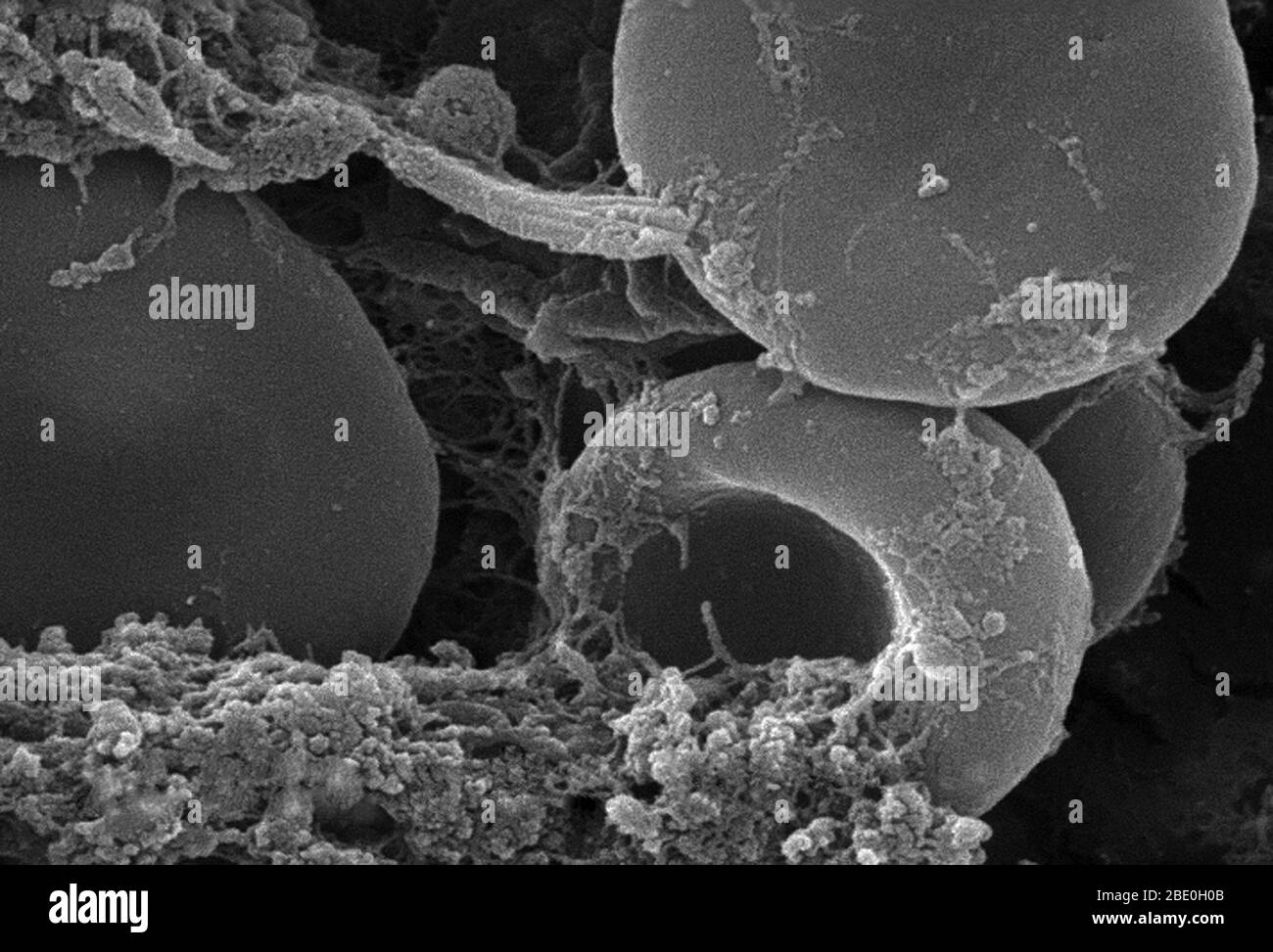 This scanning electron micrograph (SEM) depicted a number of red blood cells found enmeshed in a fibrinous matrix on the luminal surface of an indwelling vascular catheter; Magnified 11432x Note the biconcave cytomorphologic shape of each erythrocyte, which increases the surface area of these hemoglobin-filled cells, thereby, promoting a greater degree of gas exchange, which is their primary function in an in vivo setting. In their adult phase, these cells possess no nucleus. What appears to be irregularly-shaped chunks of debris, are actually fibrin clumps, which when inside the living organi Stock Photo