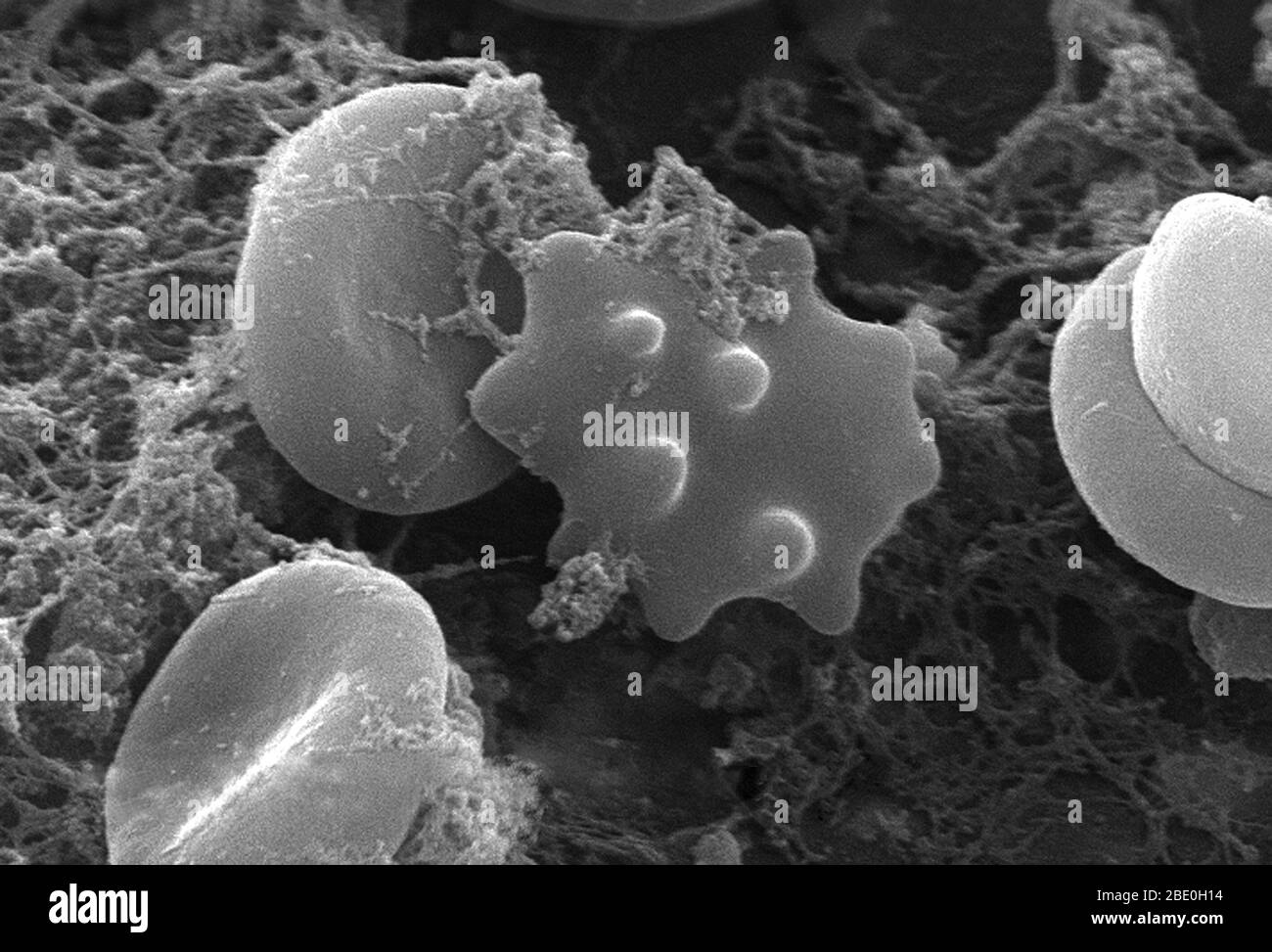 SEM depicting red blood cells found enmeshed in a fibrinous matrix on the luminal surface of an indwelling vascular. The erythrocyte in the center had undergone the process of crenation, whereupon, it developed a number of cell wall projections, thereby, transforming it into what is termed an acanthocyte. Acanthocytosis could be indicative of a number of hematologic disease processes, but in this instance, was probably due to the fixation procedure carried out on this specimen prior to electron micrographic viewing. Note the normally appearing, biconcave cytomorphologic shape of the other eryt Stock Photo