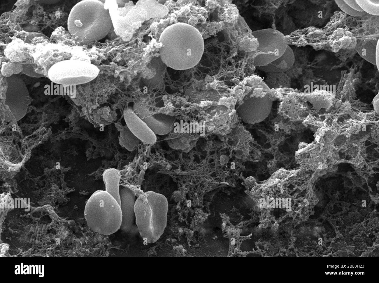 This scanning electron micrograph (SEM) depicted a number of red blood cells found enmeshed in a fibrinous matrix on the luminal surface of an indwelling vascular catheter; Magnified 2858x. Note the biconcave cytomorphologic shape of each erythrocyte, which increases the surface area of these hemoglobin-filled cells, thereby, promoting a greater degree of gas exchange, which is their primary function in an in vivo setting. In their adult phase, these cells possess no nucleus. What appears to be irregularly-shaped chunks of debris, are actually fibrin clumps, which when inside the living organi Stock Photo