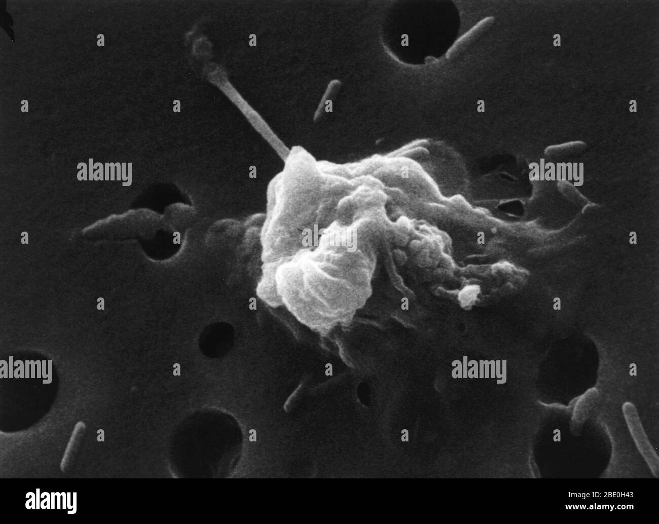 #6 in a six-step sequence of the death of a cancer cell. A cancer cell has migrated through the holes of a matrix coated membrane from the top to the bottom, simulating natural migration of a invading cancer cell between, and sometimes through, the vascular endothelium. Notice the spikes or pseudopodia that are characteristic of an invading cancer cell (1). A buffy coat containing red blood cells, lymphocytes and macrophages is added to the bottom of the membrane. A group of macrophages identify the cancer cell as foreign matter and start to stick to the cancer cell, which still has its spikes Stock Photo