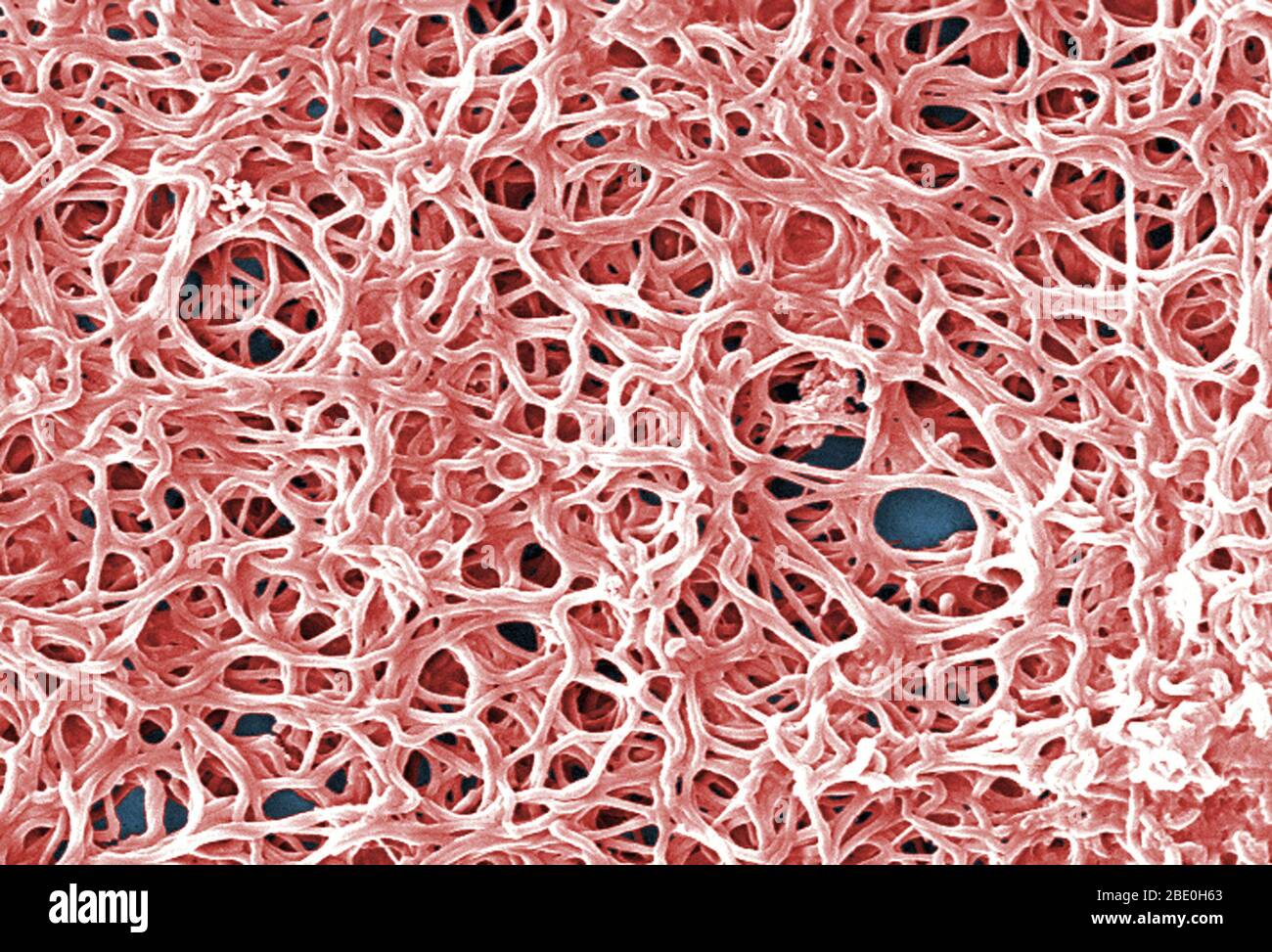 Scanning electron micrograph (SEM) depicts a grouping of numerous Gram-negative, anaerobic, Borrelia burgdorferi bacteria, which had been derived from a pure culture. This pathogenic organism is responsible for causing the illness Lyme disease, a zoonotic, vector-borne ailment, transmitted to humans by way of a tick bite. B. burgdorferi belongs to a group of bacteria called spirochetes, whose appearance resembles a coiled spring. B. burgdorferi bacteria can infect several parts of the body, producing different symptoms at different times. Not all patients with Lyme disease will have all sympto Stock Photo