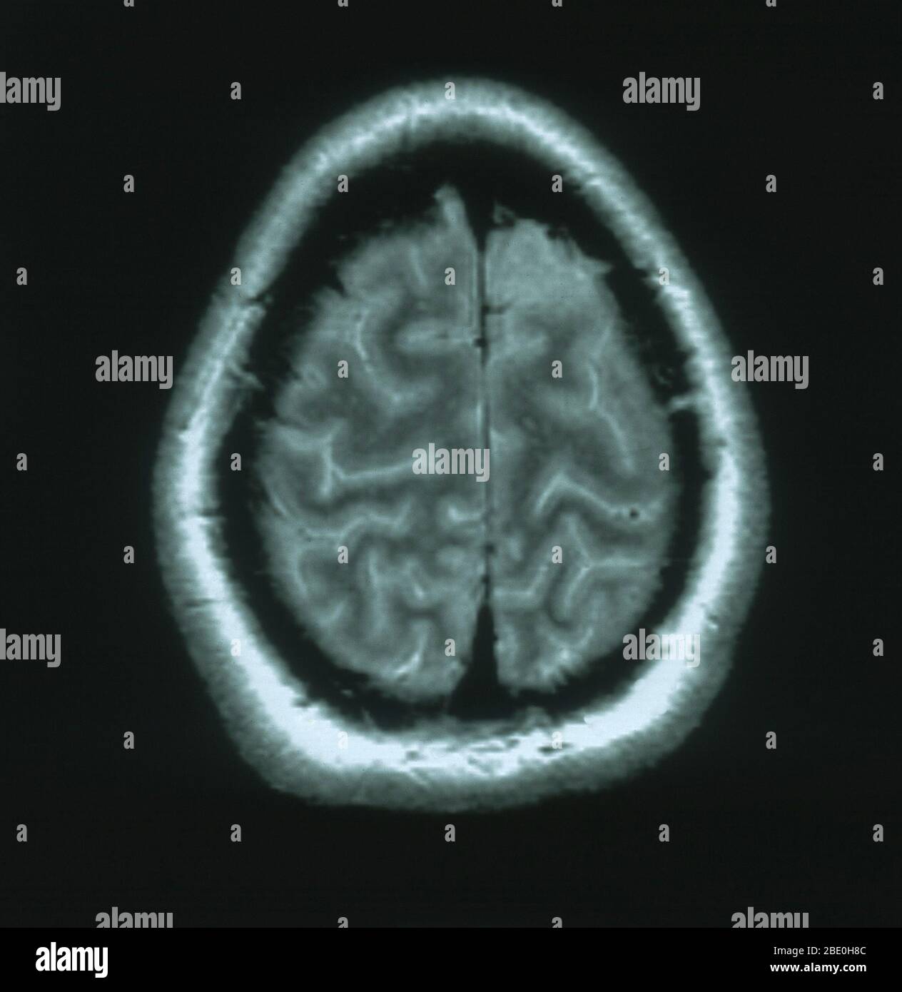 MRI scan, T2 weighted, axial view through the brain of a 54 year old female. The MRI is normal. Stock Photo
