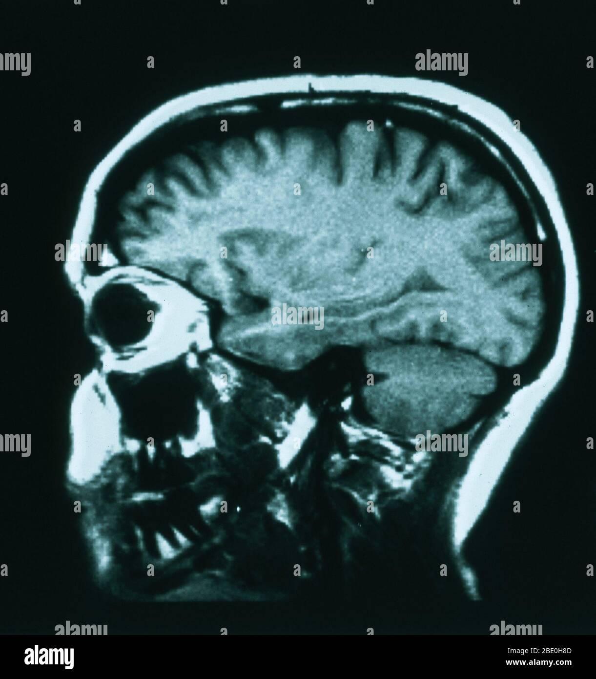 Sagittal (from the side) T1 weighted MRI showing normal anatomy of the brain including: the cerebral cortex, corpus callosum, thalamus, medulla oblongata, cerebellum, and brainstem. Stock Photo