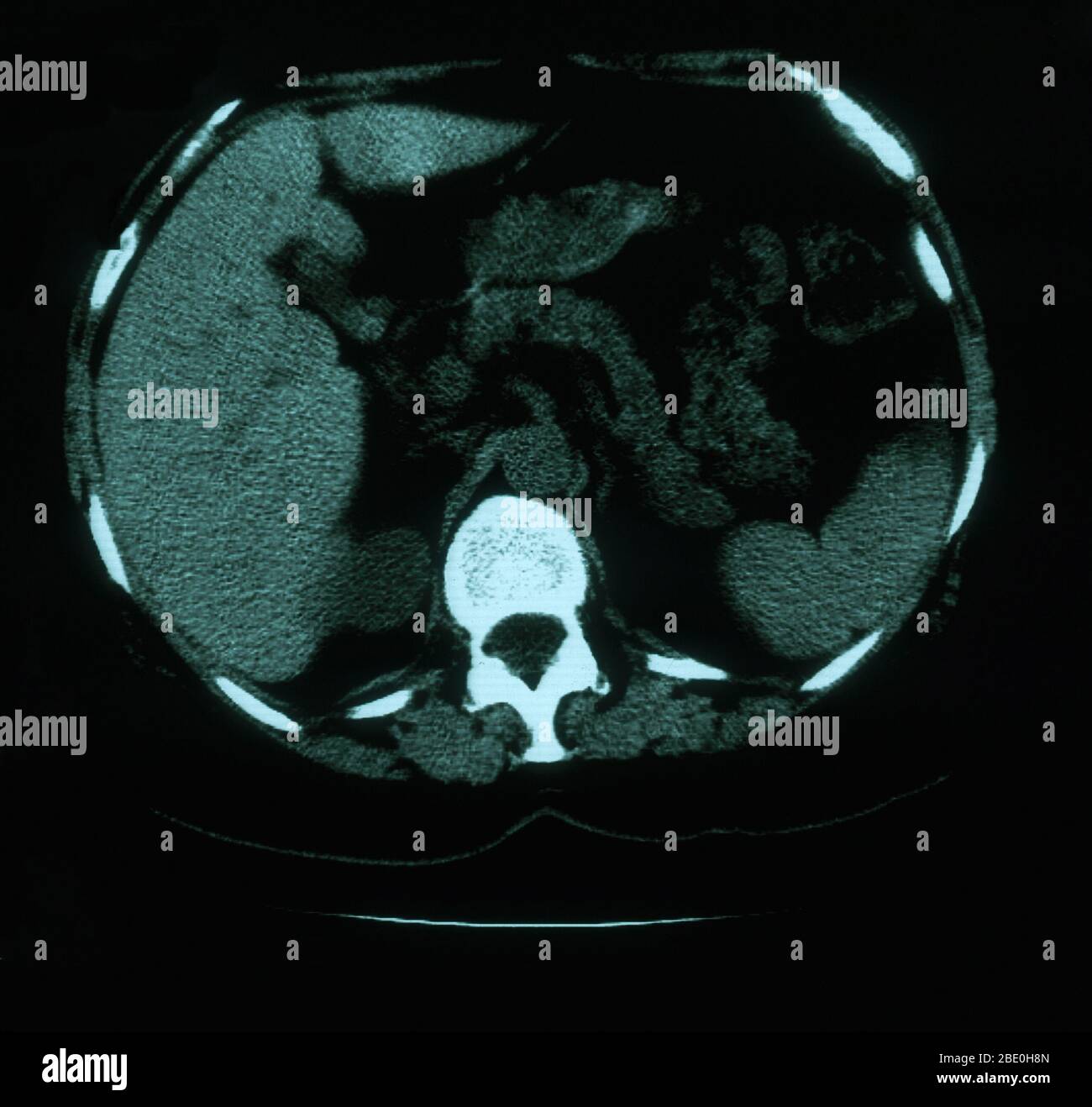 An axial (cross sectional) CT image through the lungs of a 53 year old female. The scan shows tortuosity and prominence of vasculature in the right superior mediastinum. Also present are calcified left hilar nodules and multiple punctate calcifications throughout the spleen which are consistent with granuloma. Stock Photo