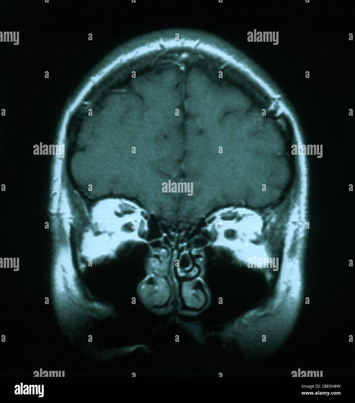 MRI scan, T1 weighted, axial view through the brain of a 54 year old female. The MRI is normal. Stock Photo