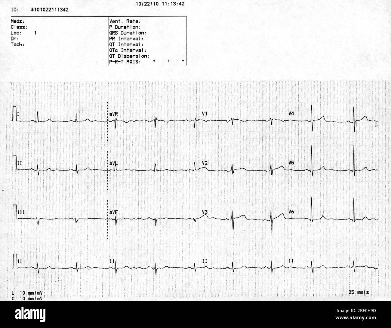 Normal electrocardiogram (EKG) of a 60-year-old female. Stock Photo