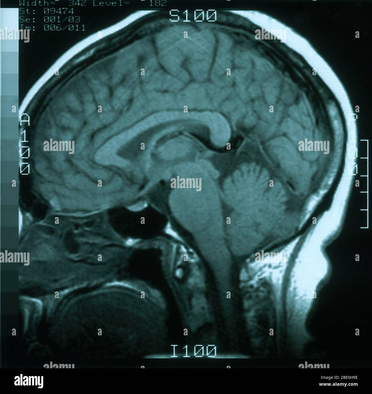 MRI scan, T1 weighted, sagittal view through the brain of a 54 year old female. The MRI is normal. Stock Photo
