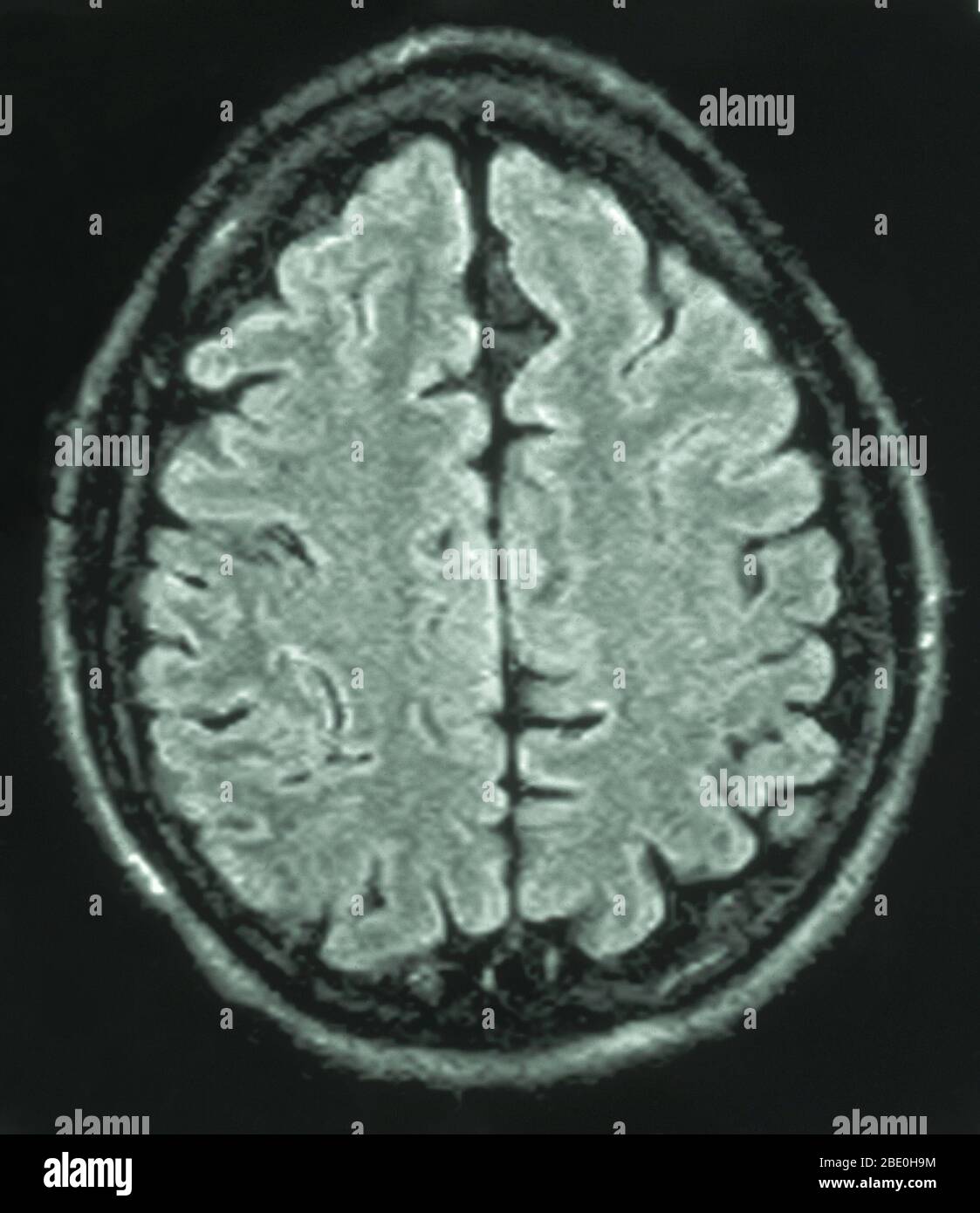 MRI of the brain (axial view) of a 26 year old male. The MRI was taken as a result of head injury in a car accident. Diagnosis from the MRI's is a small arachnoid cyst in the parasagittal anterior left frontal region. All other aspects appear normal. Stock Photo