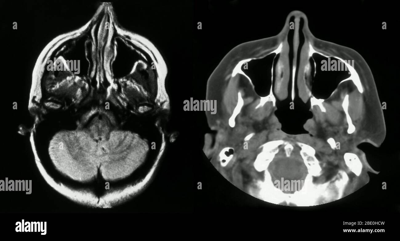 MRIs showing the normal brain and sinuses. Stock Photo