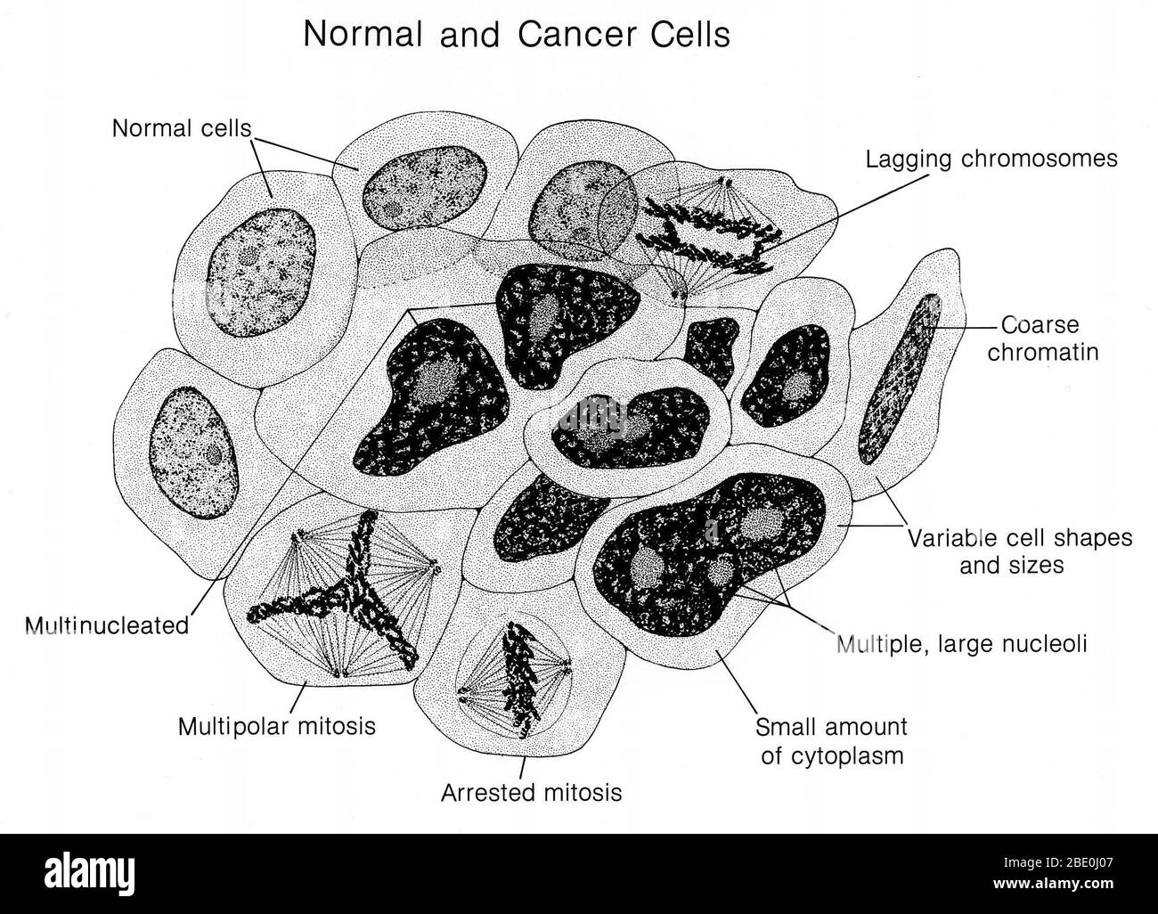 Illustration of normal and cancer cells side-by-side. The normal and cancerous characteristics are identified. Cancer also known as a malignant tumor or malignant neoplasm, is a group of diseases involving abnormal cell growth with the potential to invade or spread to other parts of the body. Not all tumors are cancerous; benign tumors do not spread to other parts of the body. Possible signs and symptoms include: a new lump, abnormal bleeding, a prolonged cough, unexplained weight loss, and a change in bowel movements among others. While these symptoms may indicate cancer, they may also occur Stock Photo