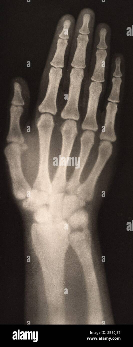Historical X-ray of a woman's hand, 1896. Taken by Josef Maria Eder (Austrian, 1855-1944) and Eduard Valenta (Austrian, 1857-1937). Photogravure. Eder was the director of an institute for graphic processes and the author of an early history of photography. With the photochemist Valenta, he produced a portfolio in January 1896, less than a month after Wilhelm Conrad Rontgen published his discovery of X-rays. Eder and Valenta's volume, from which this plate derives, demonstrated the X-ray's magical ability to reveal the hidden structure of living things. Human hands and feet, fish, frogs, a snak Stock Photo